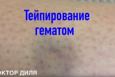 Тейпирование гематом
